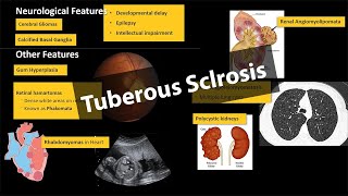 Tuberous Sclerosis  Pathology amp Clinical Features WITH PHOTOS [upl. by Amethist]