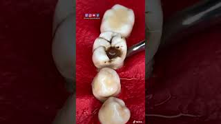 ¡🔥Simulación de extracción dental ❌🦷🔥 [upl. by Ayikat]