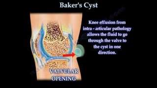 Bakers Cyst  Everything You Need To Know  Dr Nabil Ebraheim [upl. by Adnohsat]