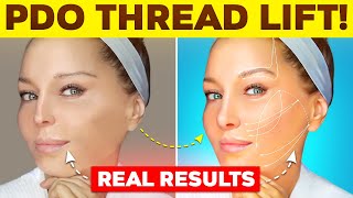 Get a Facelift in Minutes NOT Years with PDO Threads [upl. by Aenitsirhc]