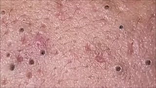 角栓 除去 blackheads removal 090 [upl. by Sierra]