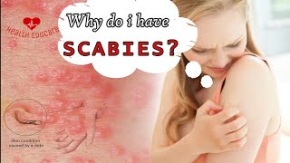 Scabies mites coming out of my skin [upl. by Rexana]