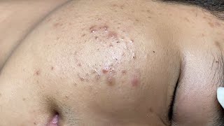 ACNE TREATMENT VU QUYNH MI  Blackheads On Boy Face 2024FULL [upl. by Hilel]