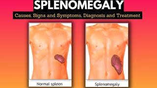 Splenomegaly Causes Signs and Symptoms Diagnosis and Treatment [upl. by Atteram]