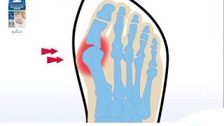 How to Correct an Hallux Valgus and Relieve Bunion Pain  EPITACT at Boots [upl. by Ofloda]