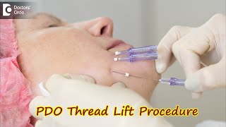 PDO Thread Lift Procedure How is it done Benefits and Side EffectsDrSrikanth V  Doctors Circle [upl. by Elvera422]