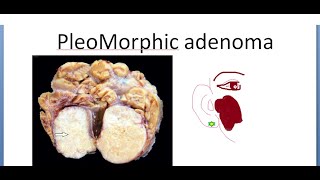 Pathology 533 a Pleomorphic Adenoma Mixed Salivary Tumor Gland Parotid Benign Lacrimal [upl. by Nerland]