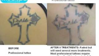 Laser Tattoo Removal Before and After Photos [upl. by Aserehs]