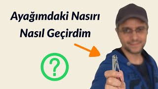 Ayağımdaki Nasırı Nasıl Geçirdim Çok Şaşıracaksınız [upl. by Grimaldi243]