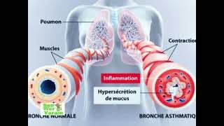 Sen wer gi yaram 803 Les types d asthme [upl. by Nellak]