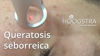 Queratosis seborreica 15163 [upl. by Ahcim]