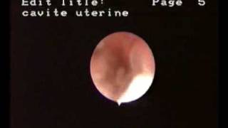 Hysteroscopic aspect of endometrial cancer [upl. by Salesin]