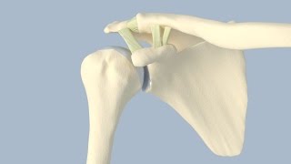 Acromioclavicular Separation Surgery [upl. by Nevek361]