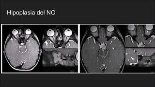 Radiología en 5 minutos Hipoplasia Nervio Óptico [upl. by Willey129]