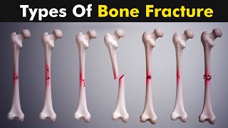 Common types of Bone fracture  3D animation [upl. by Towny]