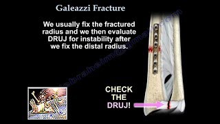 Galeazzi Fracture  Everything You Need To Know  Dr Nabil Ebraheim [upl. by Gosney68]