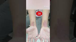 InteractiveDermatology clinic Cases 37 Koilonychia amp 38 Atopic dermatitis [upl. by Ase]