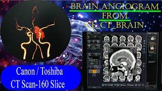 CT Brain Angiogram  From CECT Brain basicradiology [upl. by Latsryk]