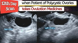 Ovarian CYSTS  Ovulation Medicines in PCOS Patient  Polycystic Ovaries  Infertility [upl. by Oremodlab361]