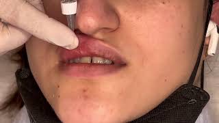 Learn Safe Lip Filler Injections Easy Steps for Perfect Lips [upl. by Lamee]