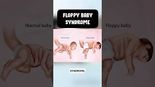 Floppy baby syndrome 👶usmle neetpg pediatrics [upl. by Maxia]