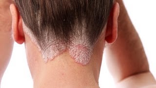 Scalp Psoriasis Shampoo  Do They Really Work [upl. by Stephenson]