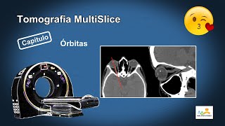 Planejamento do Exame de Órbitas por Tomografia [upl. by Hanikahs96]