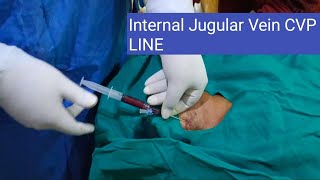 CVP line procedure through intra jugular veinenglish hospital telugu viralvideo [upl. by Hebner]