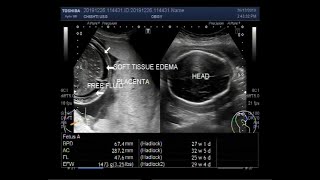 Ultrasound Video showing scanning of Pregnancy of about 28 weeks with fetal demise [upl. by Sterrett]