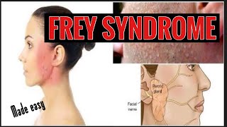 FREY SYNDROME II GUSTATORY SWEATING II AURICULOTEMPORAL SYNDROME II ORAL SURGERY [upl. by Nylek]