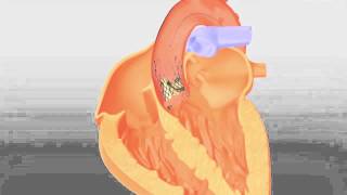 CoreValve  Transcatheter Aortic Valve Replacement by Medtronic [upl. by Fennessy30]