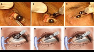 Probing and Dilators of surgical instruments [upl. by Monney]