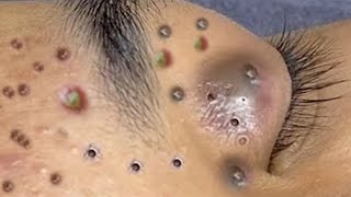 Big Cystic Acne Blackheads Extraction Blackheads amp Milia Whiteheads Removal Pimple Popping  6749 [upl. by Neurath]