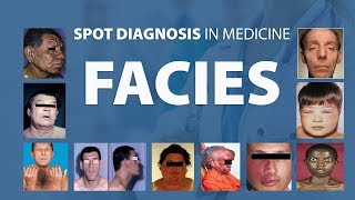 Abnormal Facies  Spot Diagnoses in Medicine [upl. by Llewop]