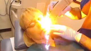 VBeam laser treatment for rosacea [upl. by Atterg841]