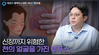 류마티스내과 자가면역질환 루푸스를 의심할 수 있는 증상과 치료 방법 [upl. by Hendricks854]