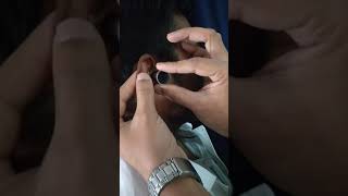 TOYNBEES SPECULUM FOR EAR EXAMINATION [upl. by Hgielek]