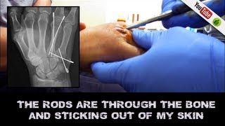 Removing 4 rods pins from Boxers Break  No anesthetic [upl. by Gunilla787]