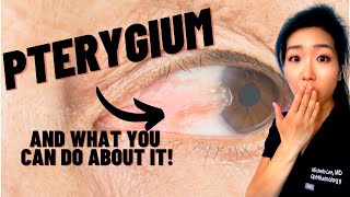 What Is A Pterygium  Causes Symptoms And Treatments For Surfers Eye [upl. by Orips]