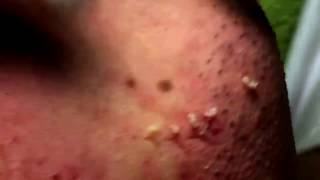 Acne Solution  Blackheads amp Whiteheads Removal 1  How to get rid of acne [upl. by Daveta544]