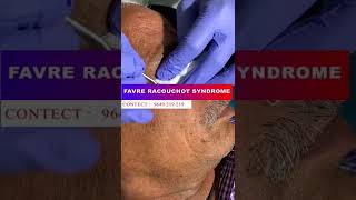 Things You Most Likely Didnt Know About Favre Racouchot Syndrome favreracouchotsyndrome shorts [upl. by Eleni749]