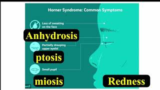 Horner Syndrome [upl. by Elison]