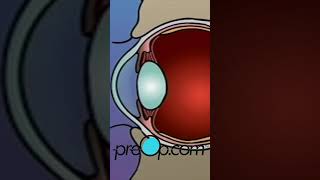 PreOp® 👁️ What to Expect with LASIK Laser Eye Surgery preop shorts health 🌟 [upl. by Enerol]