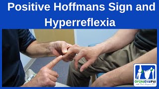 Positive Hoffmans Sign and Hyperreflexia [upl. by Nirel]