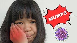 Mumps  Causes Signs amp Symptoms Diagnosis And Treatment [upl. by Irrabaj]