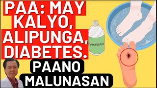 Paa May Kalyo Alipunga Diabetes By Doc Willie Ong [upl. by Tniassuot221]