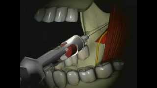 Mandibular Anesthesia  Inferior Alveolar Nerve Block [upl. by Lashonda94]