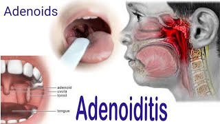 Adenoiditis  Adenoids  Symptoms Causes Complications Diagnosis and Treatment [upl. by Truscott]