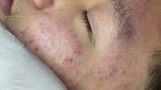 Loan Nguyen Acne Treatment 15777 [upl. by Cora]