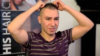 Scalp MicroPigmentation  AJ goes to HIS Hair Clinic after  DermMatch Concealer User [upl. by Aeli]